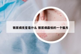 银屑病克星是什么 银屑病最怕的一个偏方