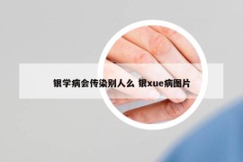 银学病会传染别人么 银xue病图片