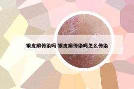 银皮癣传染吗 银皮癣传染吗怎么传染