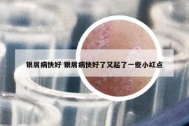 银屑病快好 银屑病快好了又起了一些小红点