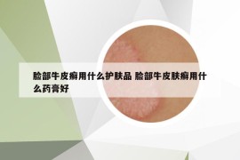 脸部牛皮癣用什么护肤品 脸部牛皮肤癣用什么药膏好