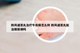 防风通圣丸治疗牛皮癣怎么样 防风通圣丸能治银屑病吗