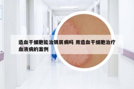 造血干细胞能治银屑病吗 用造血干细胞治疗血液病的案例