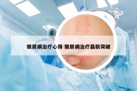 银屑病治疗心得 银屑病治疗最新突破