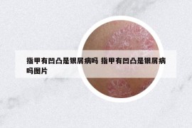 指甲有凹凸是银屑病吗 指甲有凹凸是银屑病吗图片