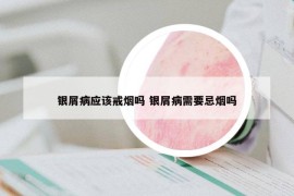 银屑病应该戒烟吗 银屑病需要忌烟吗