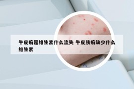 牛皮癣是维生素什么流失 牛皮肤癣缺少什么维生素