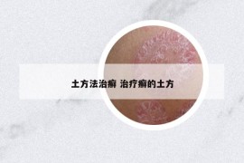 土方法治癣 治疗癣的土方