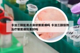 卡泊三醇能用点滴状银屑病吗 卡泊三醇搽剂治疗银屑病效果好吗