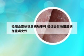 吸烟会影响银屑病加重吗 吸烟会影响银屑病加重吗女性