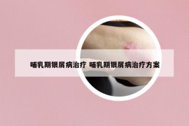 哺乳期银屑病治疗 哺乳期银屑病治疗方案