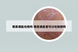 银屑病能吃桃吗 银屑病患者可以吃桃胶吗