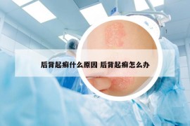 后背起癣什么原因 后背起癣怎么办