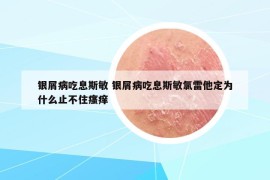 银屑病吃息斯敏 银屑病吃息斯敏氯雷他定为什么止不住瘙痒