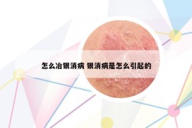 怎么冶银消病 银消病是怎么引起的