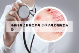 小孩子身上有藓怎么办 小孩子身上有癣怎么办