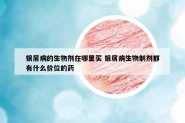 银屑病的生物剂在哪里买 银屑病生物制剂都有什么价位的药