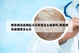 银屑病消退期起小红疹是怎么回事吗 银屑病消退期痒怎么办