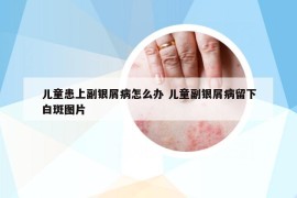 儿童患上副银屑病怎么办 儿童副银屑病留下白斑图片