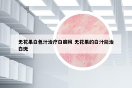 无花果白色汁治疗白癜风 无花果的白汁能治白斑