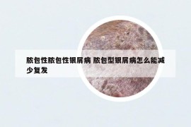 脓包性脓包性银屑病 脓包型银屑病怎么能减少复发