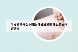 牛皮癣用什么中药洗 牛皮皮癣用什么药治疗好得快