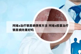 阿维a治疗银屑病使用方法 阿维a胶囊治疗银屑病效果好吗