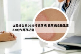 口服维生素D3治疗银屑病 银屑病吃维生素d3的作用及功能