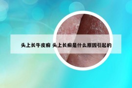 头上长牛皮癣 头上长癣是什么原因引起的