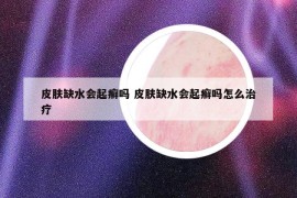 皮肤缺水会起癣吗 皮肤缺水会起癣吗怎么治疗