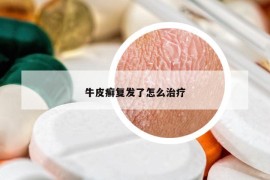 牛皮癣复发了怎么治疗