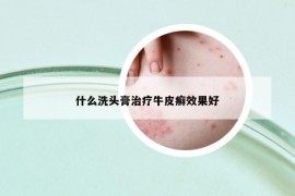 什么洗头膏治疗牛皮癣效果好