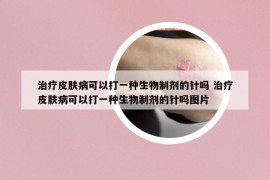 治疗皮肤病可以打一种生物制剂的针吗 治疗皮肤病可以打一种生物制剂的针吗图片