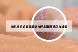 哺乳期妈妈长银屑病 哺乳期银屑病怎样缓解