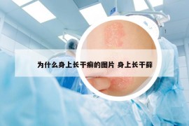 为什么身上长干癣的图片 身上长干藓