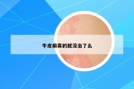 牛皮癣真的就没治了么