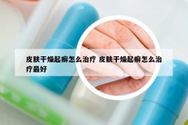 皮肤干燥起癣怎么治疗 皮肤干燥起癣怎么治疗最好