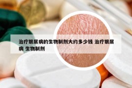 治疗银屑病的生物制剂大约多少钱 治疗银屑病 生物制剂