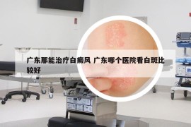 广东那能治疗白癜风 广东哪个医院看白斑比较好