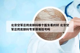 北京空军总院皮肤科哪个医生看的好 北京空军总院皮肤科专家很难挂号吗
