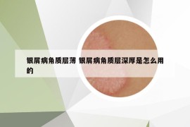 银屑病角质层薄 银屑病角质层深厚是怎么用的