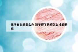 孩子有头癣怎么办 孩子得了头癣怎么才能断根