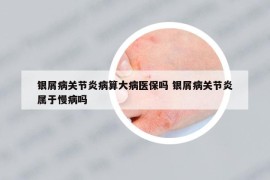 银屑病关节炎病算大病医保吗 银屑病关节炎属于慢病吗