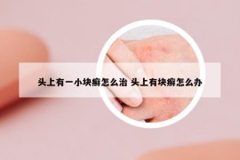 头上有一小块癣怎么治 头上有块癣怎么办