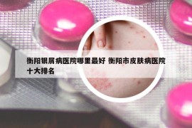 衡阳银屑病医院哪里最好 衡阳市皮肤病医院十大排名