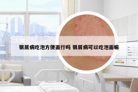 银屑病吃泡方便面行吗 银屑病可以吃泡面嘛