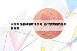 治疗银肖病和湿疹子的方 治疗银霄病的偏方有哪些