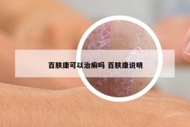 百肤康可以治癣吗 百肤康说明