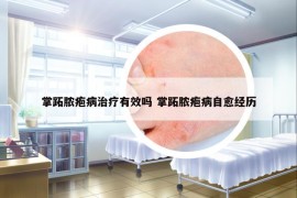 掌跖脓疱病治疗有效吗 掌跖脓疱病自愈经历