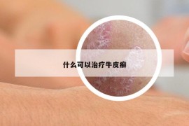 什么可以治疗牛皮癣